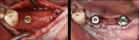 Advanced surgical techniques for reentry procedures: Vence technique for posterior sites